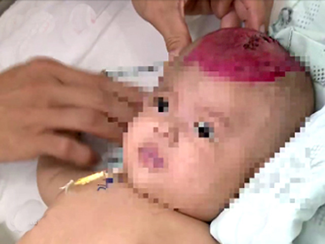 Điện thoại rơi trúng đầu, bé gái hơn 2 tháng tuổi bị chấn thương sọ não