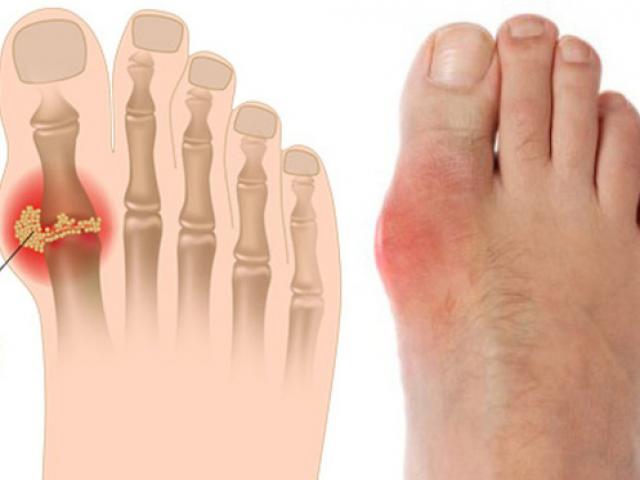 Những thói quen cần thay đổi để tạm biệt bệnh Gout