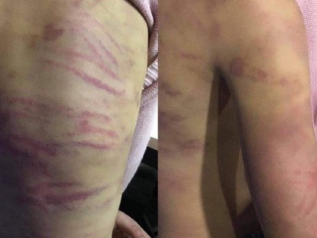 Điều tra vụ bé gái 12 tuổi bị mẹ đẻ cùng “người tình” bạo hành dã man