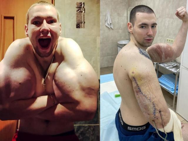 Lực sĩ đối mặt tử thần vì có bắp tay to nhất thế giới: Suýt cắt bỏ cánh tay