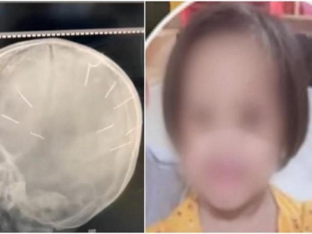 Diễn biến mới nhất về sức khỏe của bé gái 3 tuổi bị người tình của mẹ đóng 9 đinh vào đầu