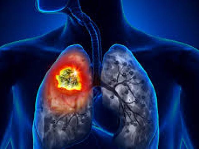 96,8% người Việt bị ung thư phổi đều nghiện 'món' này