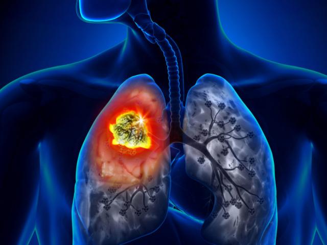 10 nghề nghiệp gây tổn thương phổi khủng khiếp, nguy cơ ung thư cận kề