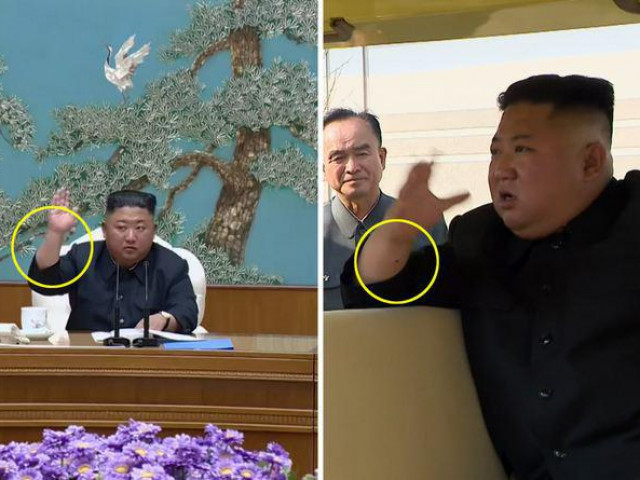 Báo Hàn: Ông Kim Jong-un có thể đã trải qua thủ thuật y tế