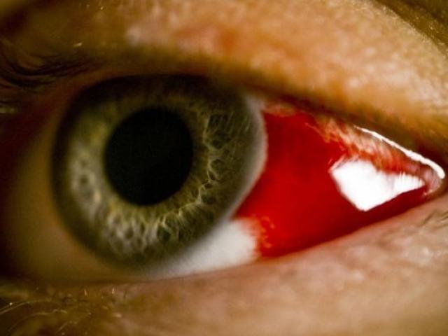 Quốc gia khốn đốn với bệnh ”khóc ra máu” và dịch Covid-19