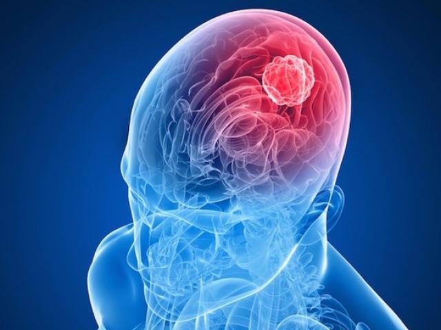 8 dấu hiệu âm thầm của căn bệnh ”sát thủ” mang tên ung thư não