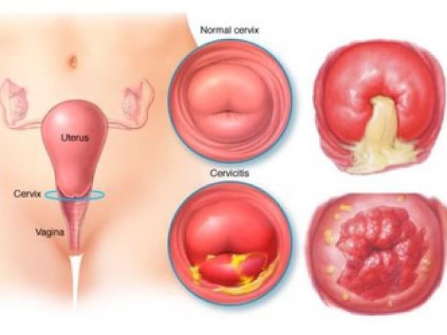 19, 20 tuổi ung thư cổ tử cung: Bác sĩ chỉ ra nguyên nhân nhiều bạn trẻ sẽ giật mình