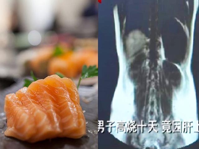 Ăn hải sản theo cách này suốt 3 năm, người đàn ông bị nhiễm sán trong gan