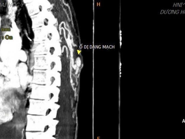 Nặn mụn ở lưng, máu phun thành tia, nam thanh niên bất ngờ phát hiện bệnh này