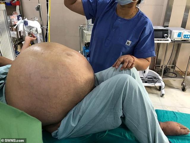 Ấn Độ: Tăng cân đột biến lên đến hơn 100 kg, người phụ nữ sốc khi biết sự thật