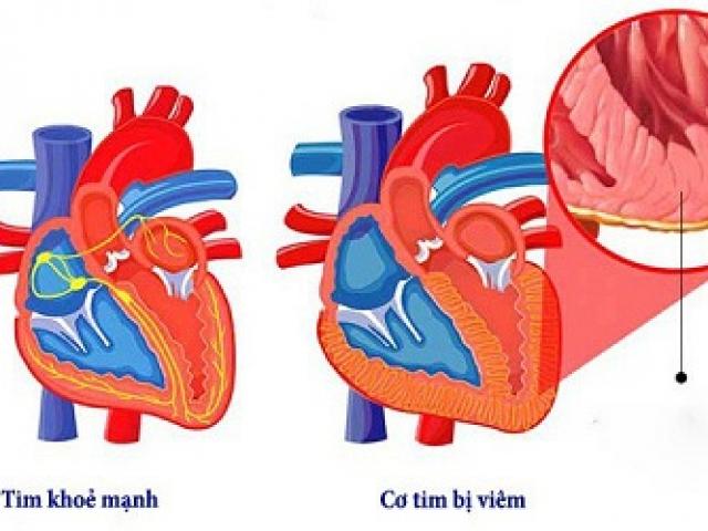COVID-19 có thể ảnh hưởng đến tim, ngay cả sau khi đã hồi phục