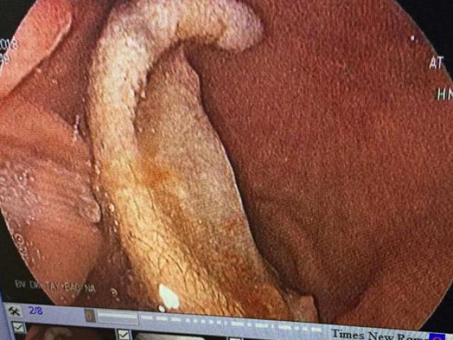 Nội soi lấy phần tai bị cắn đứt trong bụng một học sinh