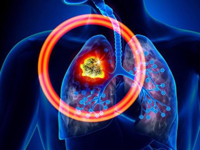 Nhiều người ”thiêu rụi” 2 lá phổi, rước ung thư vì không biết những điều này