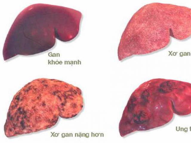 Giám đốc BV K hướng dẫn cách phòng bệnh ung thư có tỷ lệ mắc mới nhiều nhất tại Việt Nam