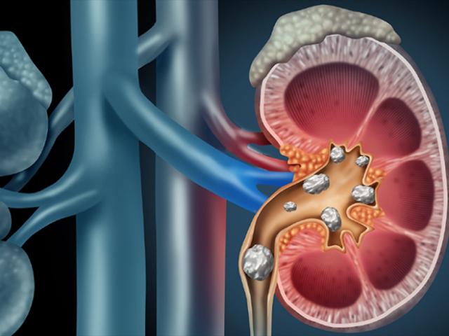 Khiến 2 quả thận quý hơn vàng chứa đầy sỏi là vì bạn chưa biết những điều này