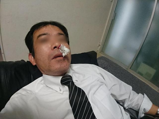 Người đàn ông 33 tuổi bị ung thư vòm họng vì chủ quan những triệu chứng giống viêm mũi