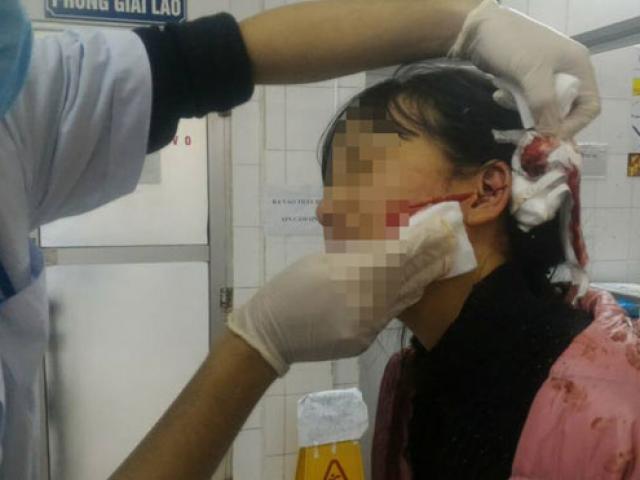Nữ sinh cấp 3 xinh đẹp bị đâm rách mặt vì mâu thuẫn ngoài chợ