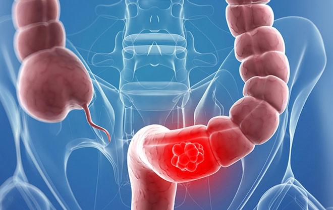 Khắc phục viêm đại tràng nhờ công nghệ độc đáo của người Nhật - 1