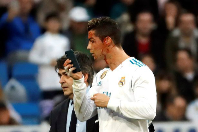 Tin HOT bóng đá tối 27/1: Bị thương mặt, Ronaldo vẫn tin mình đẹp trai - 1