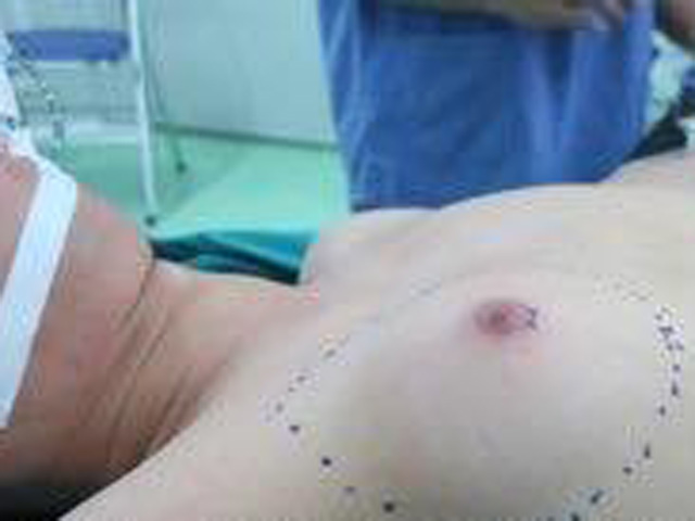 Người đàn ông 30 tuổi có ngực khủng như phụ nữ - 1