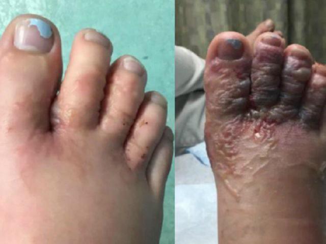 Phi thường - kỳ quặc - Trả giá đắt vì đi chân trần trên bãi biển