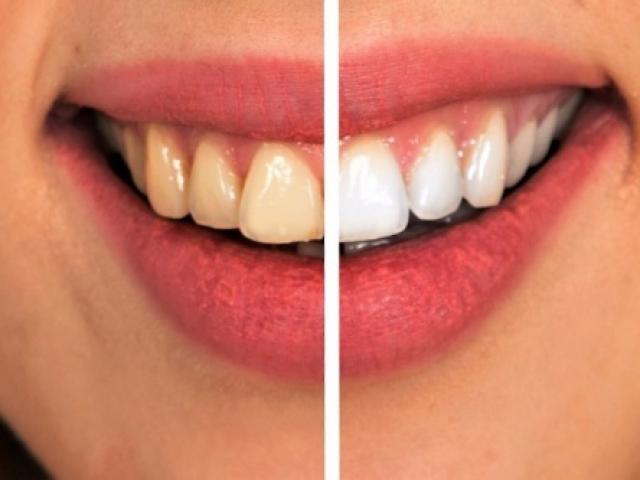 8 cách đơn giản đẩy lùi bệnh sâu răng một cách tự nhiên nhất