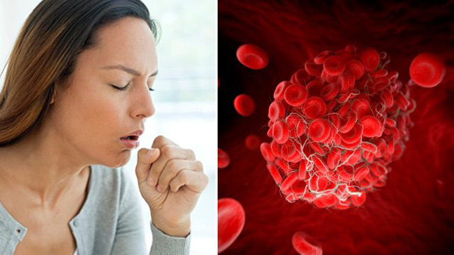 Dấu hiệu đơn giản cảnh báo cơ thể đang gặp nguy hiểm vì có cục máu đông - 3