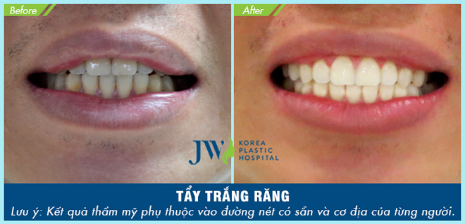 Răng đẹp tự nhiên, tài lộc vô biên, đẹp không tốn tiền! - 4