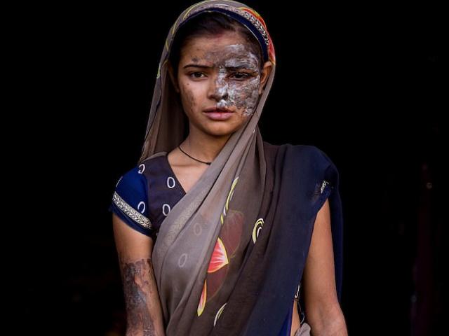 An ninh - Xã hội - Thảm cảnh của cô gái xinh nhất vùng bị phá hủy nhan sắc vì tố cáo cha đẻ