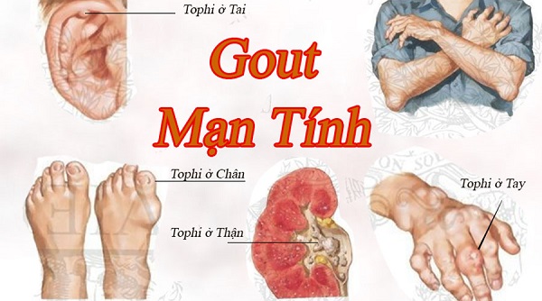 Bệnh gout là gì? Nguyên nhân và cách chữa nhanh nhất - 1