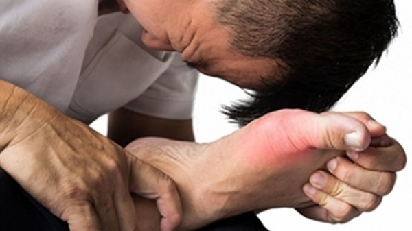 Bệnh gout là gì? Nguyên nhân và cách chữa nhanh nhất - 2