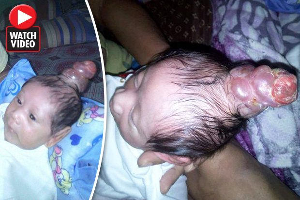 Philippines: Bé trai “mọc sừng” trên đầu khiến bác sĩ sửng sốt - 1