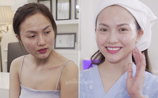 Mách chiêu “dẹp loạn” khi mụn nhọt đua nhau nổi dậy - 1