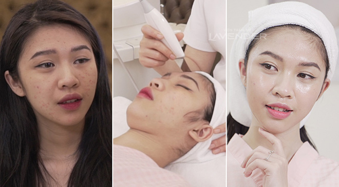 Mách chiêu “dẹp loạn” khi mụn nhọt đua nhau nổi dậy - 4