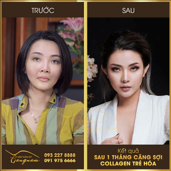 Thật hư công nghệ vượt thời gian của Viện căng chỉ Gangnam - Tập đoàn thẩm mỹ Mega Hàn Quốc - 2