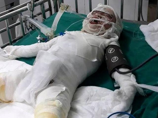 Tin tức trong ngày - Thương tâm: Bé gái tử vong do ngã vào hố vôi