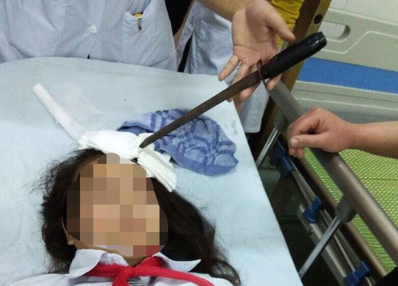 Nóng 24h qua: Nữ sinh nhập viện với cây dao cắm thẳng trên trán - 1