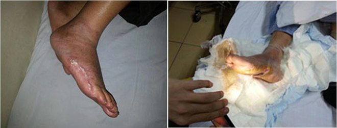 Tê bì chân tay như kim châm, kiến bò do tiểu đường: Đừng chủ quan, nguy cơ dẫn đến tàn phế - 2