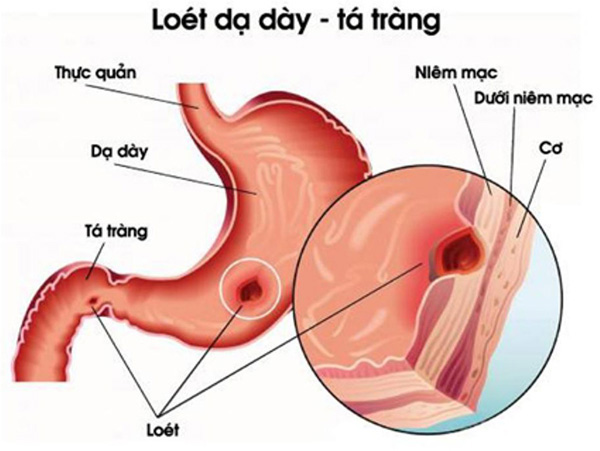 Lý do viêm loét hang vị, viêm loét dạ dày, tá tràng tái đi tái lại mãi không khỏi - 1