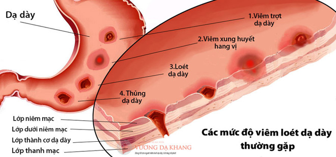 Lý do viêm loét hang vị, viêm loét dạ dày, tá tràng tái đi tái lại mãi không khỏi - 2