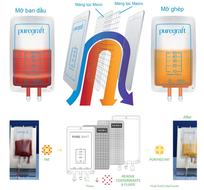 2018: Thẩm mỹ an toàn sẽ thay thế chất làm đầy bằng mỡ tự thân? - 2