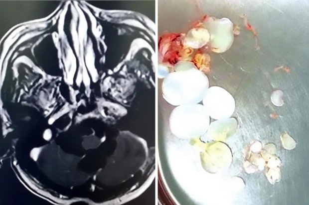 Buồn nôn đến viện khám, không ngờ phát hiện 30 trứng sán dây trong đầu - 1