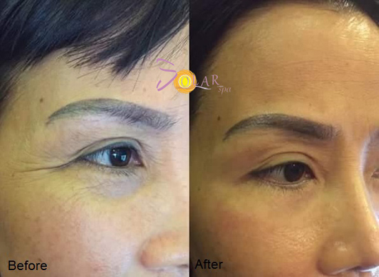 Căng da, nâng cơ mặt chảy sệ 90 phút không phẫu thuật - 1