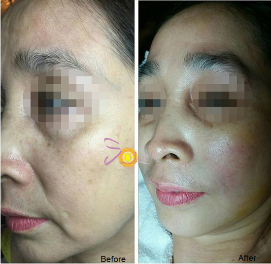 Căng da, nâng cơ mặt chảy sệ 90 phút không phẫu thuật - 2