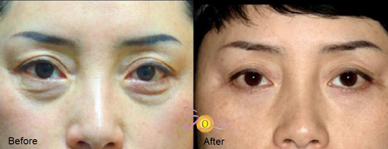 Căng da, nâng cơ mặt chảy sệ 90 phút không phẫu thuật - 4