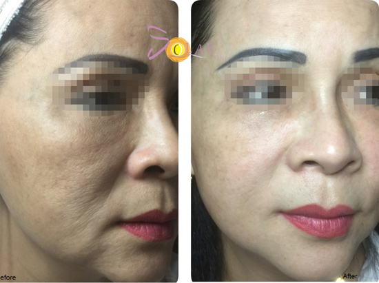 Căng da, nâng cơ mặt chảy sệ 90 phút không phẫu thuật - 5