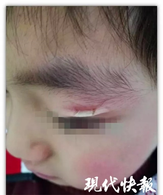 Tai nạn khó tin: Khốn khổ vì mắc kẹt mí mắt vào khóa áo - 2