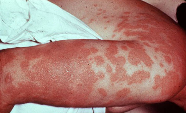 Những dịch bệnh kỳ lạ, hiện thế giới vẫn hoang mang chưa có lời giải đáp - 1