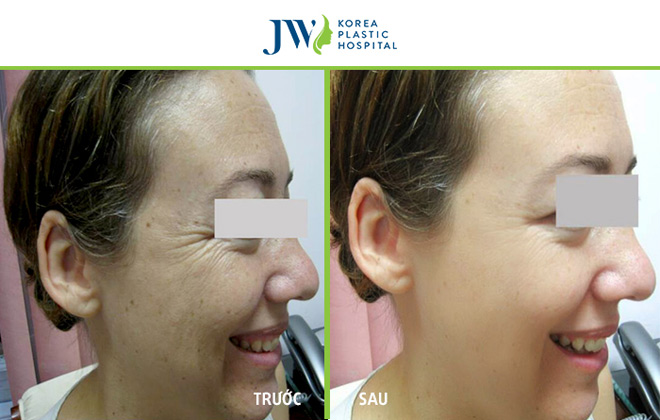 Cơ hội trẻ hoá toàn diện bằng tế bào gốc tự thân cho phái đẹp Việt - 4