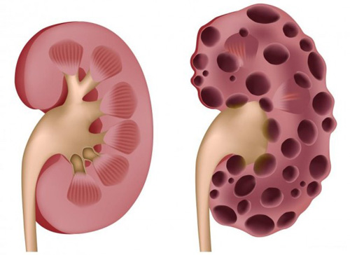 Đi tiểu 2 lần/đêm - dấu hiệu đầu tiên của suy thận - 1
